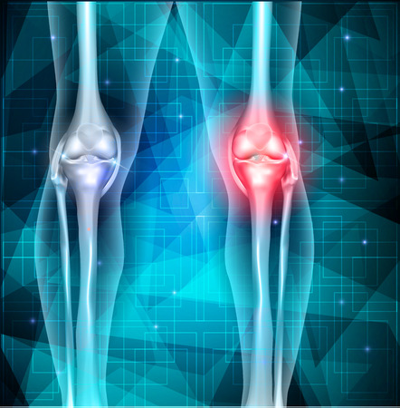 Patella Diz Kırığı 