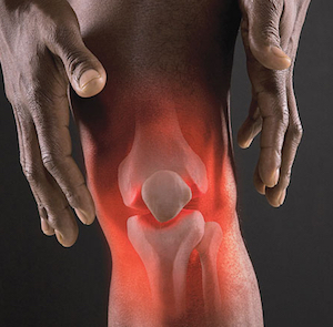 Patella Diz Kırığı
